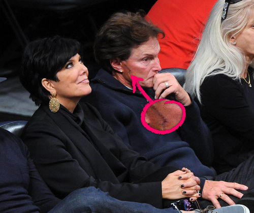 Bruce Jenner - Bruce Jenner hat eine deutliche Narbe auf der Wange Bruce Jenner - Bruce Jenner hat eine deutliche Narbe auf der Wange