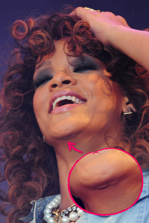 Rihanna - Rihanna zeigte sich am Wochenende mit einer bisher nie gesehenen Narbe Rihanna - Rihanna zeigte sich am Wochenende mit einer bisher nie gesehenen Narbe
