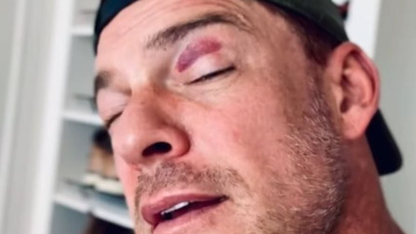 Alan Ritchson mit einem blauen Auge, Juli 2025