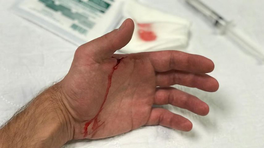 Alexander Skarsgards verletzte Hand