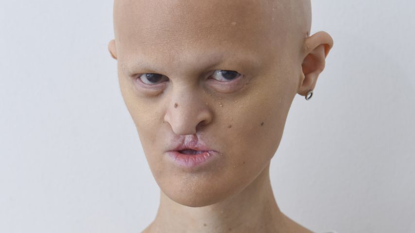Model mit Gendefekt: Melanie Gaydos will nach Berlin ziehen