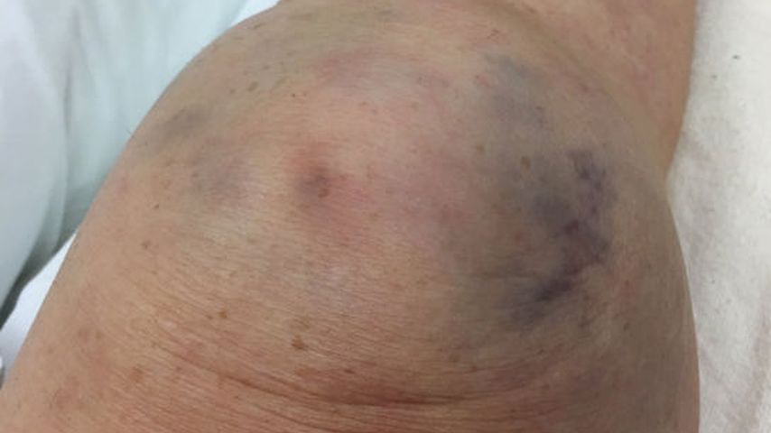 Roseanne Barr erlitt im Oktober 2016 einen Kniescheibenbruch