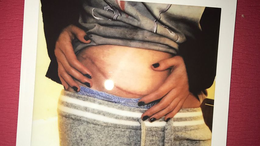Selena Gomez' Narbe ihrer Nierentransplantation