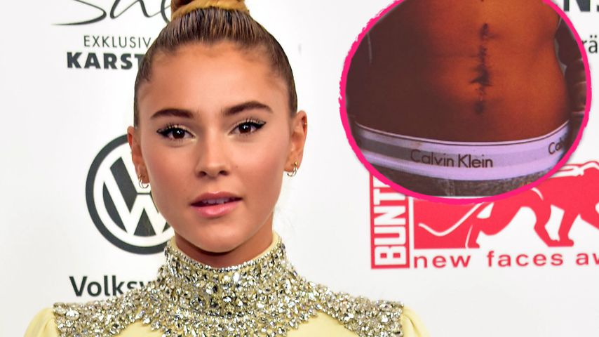 Toll! Steffi Giesinger nutzt OP-Narbe für wichtige Message