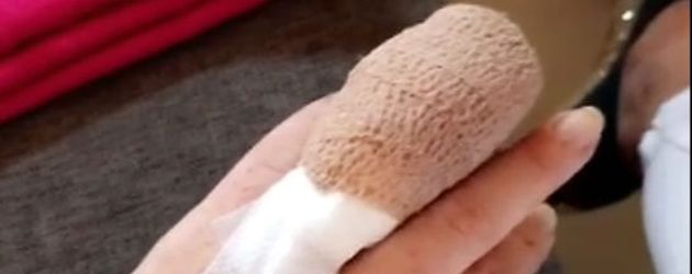 Lindsay Lohans Finger nach einer Operation Lindsay Lohans Finger nach einer Operation