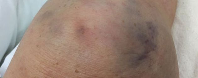 Roseanne Barr erlitt im Oktober 2016 einen Kniescheibenbruch Roseanne Barr erlitt im Oktober 2016 einen Kniescheibenbruch